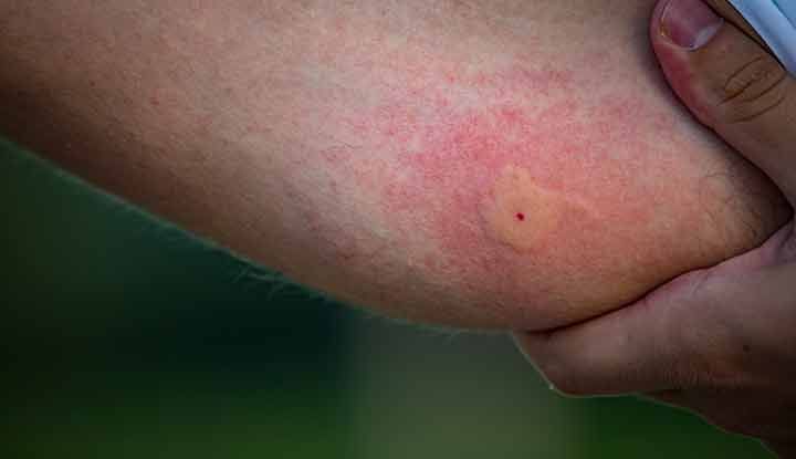 What are the most common insect borne diseases, and how do I treat them?
